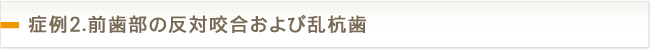 症例2.前歯部の反対咬合および乱杭歯