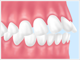 出っ歯とは